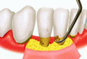 牙周病綜合治療2