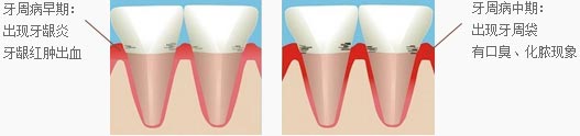 牙周病早期及中期